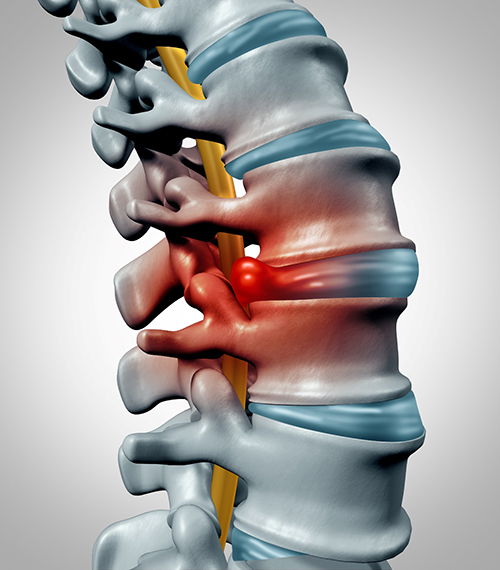 herniated disc in Richardson