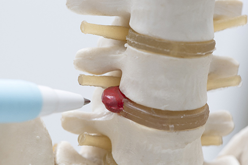 model of herniated disc in Richardson