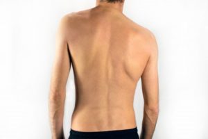 man with scoliosis in Richardson