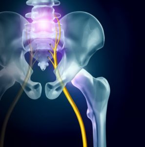 sciatica nerve triggering back pain in Richardson